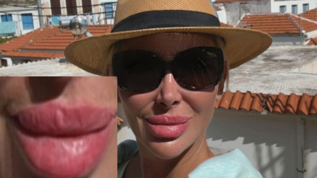Кофти хиалурон обезобрази Антония Петрова дотолкова че дори Мара Отварачката