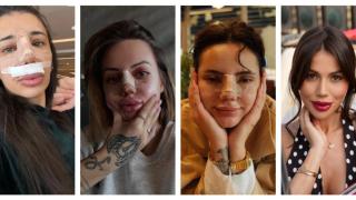 Масова истерия сред ергенките: Режат си носовете, но по-красиви ли са? (СНИМКИ)