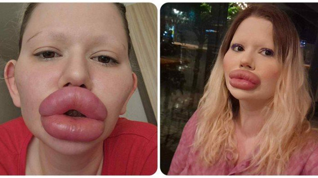 СТРАШИЛИЩЕ! БГ Барби иска още хиалурон, докторите не дават