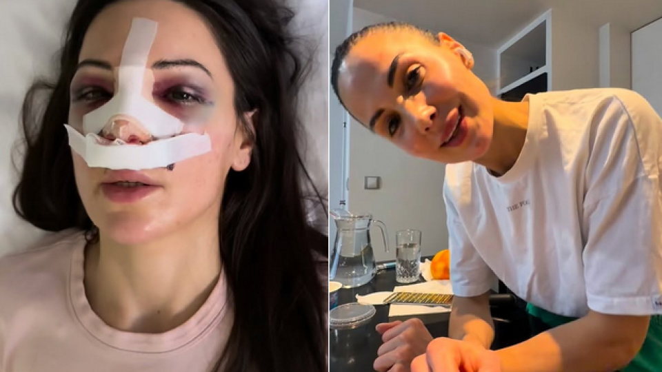 Лекар прецака носа на звезда от „Игри на волята“, прави я като Рамбо (ВИДЕО)