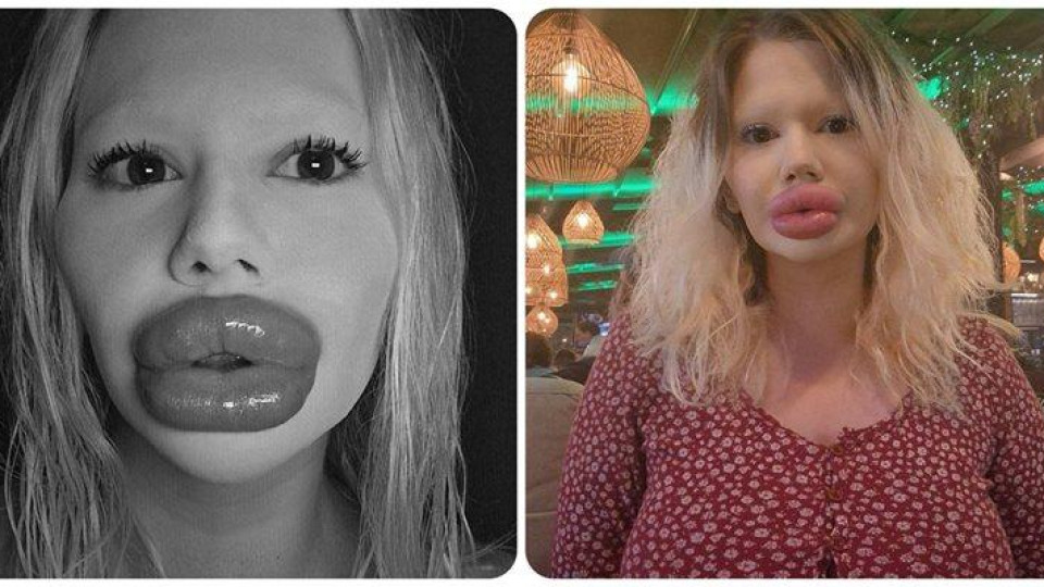 Българското Барби: Може да ослепея от хиалурона, но няма да спра!