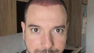 Цитиридис си присади коса