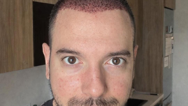 Цитиридис си присади коса