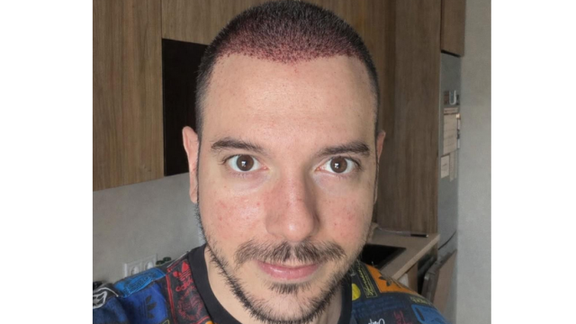 Цитиридис излъга, че  си е присадил коса